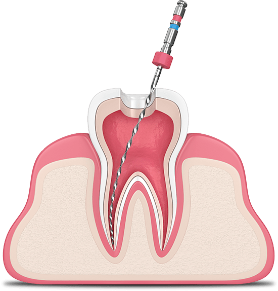 root-canal-graphic